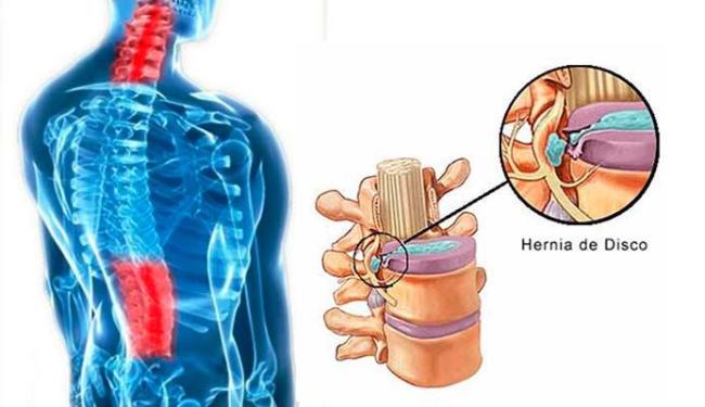 Hérnia de Disco Sintomas e Tratamento Brasil Educa