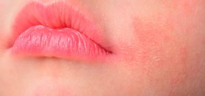Dermatite Atópica Tem Cura?Quais as Formas de Tratamento