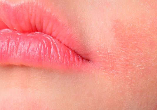 Dermatite Atopica Tem Cura