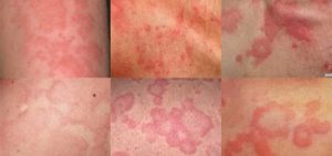Urticaria Causas,Tipos,Tratamento e Dicas